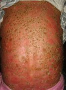 秋季预防红皮病型银屑病复发